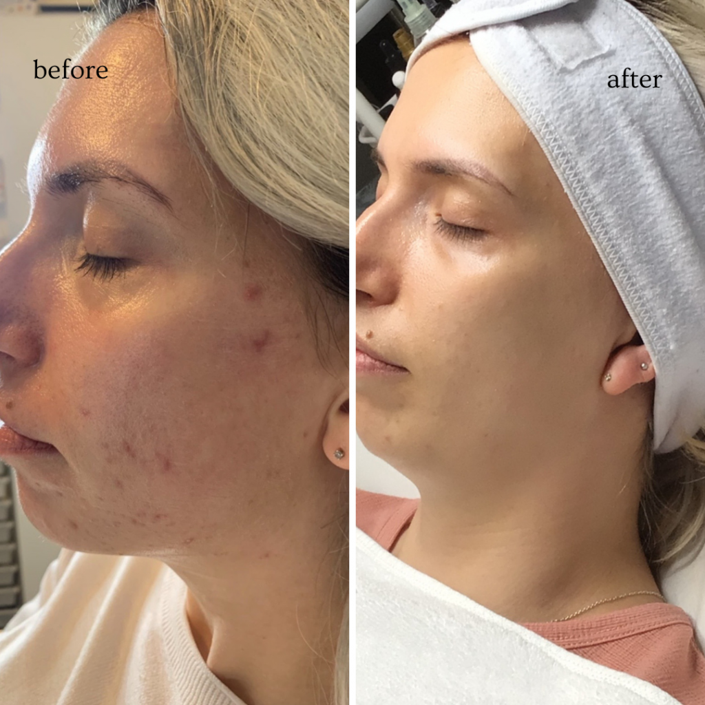skincare results