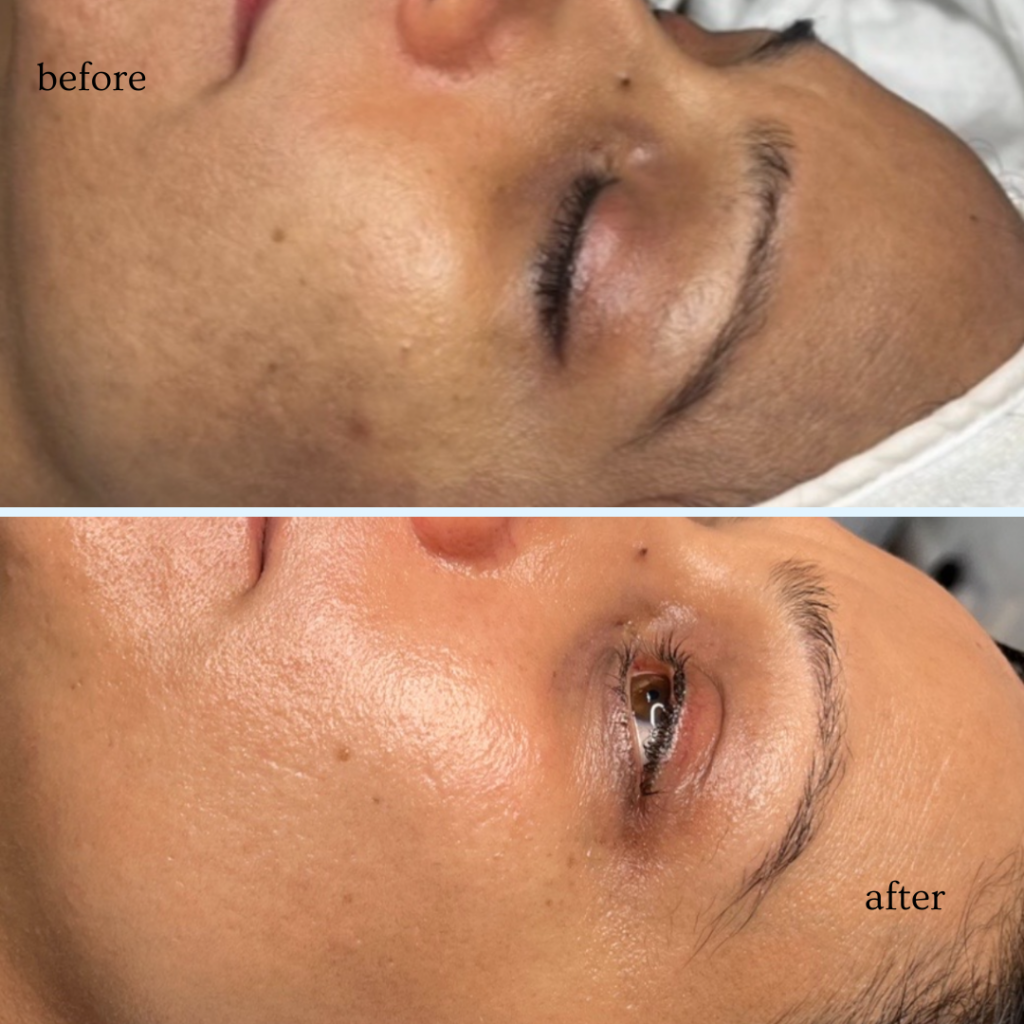 before and after picture of pigmentation treatment